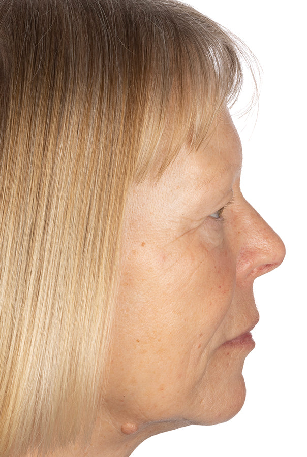 Image of participant after using absolute collagen for 12 weeks