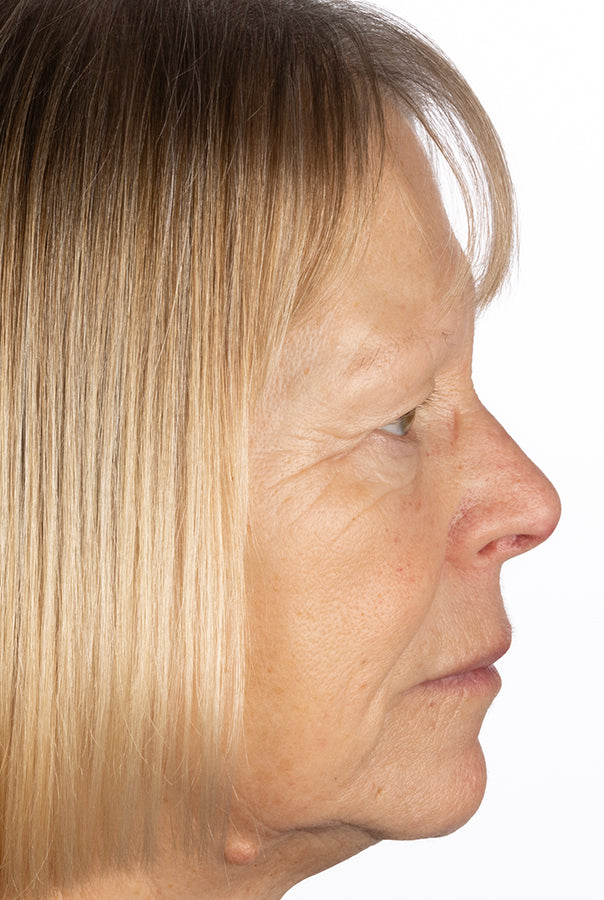 Image of participant before the collagen trial
