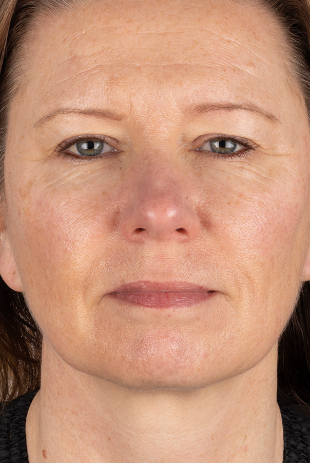 Image of participant before the collagen trial